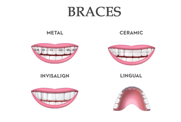 Braces
