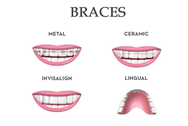 Braces